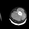 SPORK, NICO - 22.03.1976 - 02.08.2022 - CT obere Extremität - 17:56:57